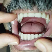 دندان سرامیکی طرح لمینت تحویل چندساعته|خدمات آرایشگری و زیبایی|محلات, |دیوار