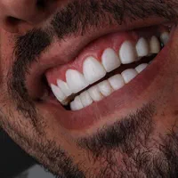 لمینت کامپوزیت ایمپلنت ارتودنسی عصب کشی|خدمات آرایشگری و زیبایی|شیراز, قصرالدشت|دیوار