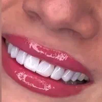 کامپوزیت دندان