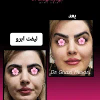 لیزر تزریق بوتاکس ژل فیلر مزوتراپی هایفو توسط پزشک