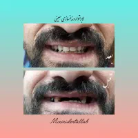 دندانسازی/دست دندان متحرک/سپیدان/هماشهر/همایجان|خدمات آرایشگری و زیبایی|شیراز, گویم|دیوار