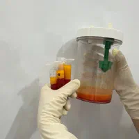 لیپوساکشن چربی و تزریق چربی