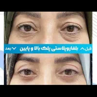 عمل زیبائی پلک پائین شامل پف ، چروک و...