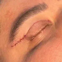 بلفاروپلاستی و برداشتن پُف چشم