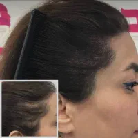 درمان دائمی موی کم پشت