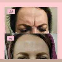 بوتاکس فقط ۹۵۰ ( پیشانی لبخند لثه ای زیر بغل و..)|خدمات آرایشگری و زیبایی|محمدیه-قزوین, |دیوار