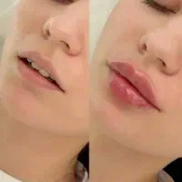 ژل فیلر و بوتاکس