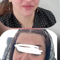 فیلر|خدمات زیبایی و سلامت|اسلام‌‌آباد غرب, |دیوار