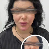 مرکزتخصصی لیفت بانخ و کانتورینگ صورت|خدمات آرایشگری و زیبایی|کرمانشاه, |دیوار