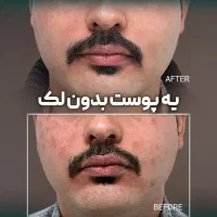 درمان کامل انواع لک پوستی توسط پزشک