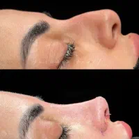 جراحی و عمل بینی