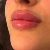 خدمات ژل فیلر بوتاکس