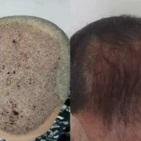 کاشت مو و ابرو|خدمات آرایشگری و زیبایی|تبریز, |دیوار