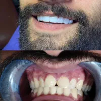 دندانسازی دندانپزشکی کامپوزیت فکی 10درمطب VlP|خدمات آرایشگری و زیبایی|رشت, استقامت ۱|دیوار
