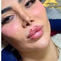 فیلربینی بوتاکس نخ ابرو لب روسیMزاویه ژل گونه پزشک|خدمات آرایشگری و زیبایی|تهران, الهیه|دیوار