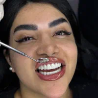 جشنواره عیدانه کامپوزیت دندان