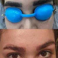 لیزر تتو و‌روشن کننده بدن