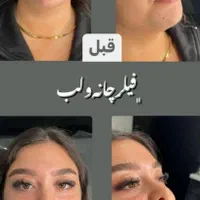 تزریق واموزش ژل بوتاکس مزوتراپی لیفت نخ...|خدمات آرایشگری و زیبایی|کرمانشاه, |دیوار