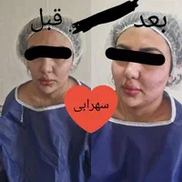 تزریق چربی صورت|خدمات آرایشگری و زیبایی|یاسوج, |دیوار