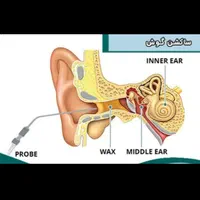ساکشن گوش-شستشوی گوش