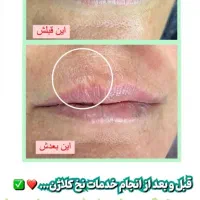 درمان حرفهای لک و ککومک و مزو تراپی|خدمات آرایشگری و زیبایی|برازجان, |دیوار