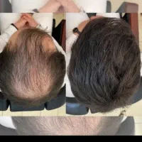 درمان ریزش مو