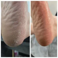 درمان ترک پا و پدیکور تخصصی