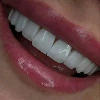 کامپوزیت.لمینت|خدمات آرایشگری و زیبایی|تهران, هفت حوض|دیوار