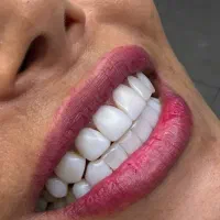 کامپوزیت نانو سرامیکی تضمینی