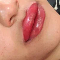 ژل بوتاکس|خدمات آرایشگری و زیبایی|دوگنبدان, |دیوار
