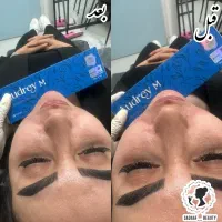 ژل و بوتاکس مزو جوانساز