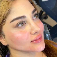 تزریق ژل و بوتاکس در کلینیک