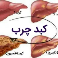 بهبود سلامت کبدومشکلات گوارشی