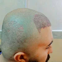 بدون زخم و بدون درد کاشت مو انجام بده