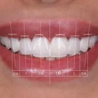 فرصت ویژه ۵۰٪ تخفیف ونیر کامپوزیت لبه شیشه ای