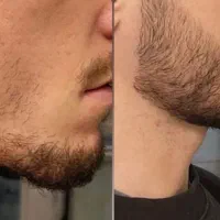 موهات خالی  شده علت داره