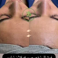 تخفیف استثنایی تمامی خدمات،فیشال ۳۸۰ پاکسازی پوست