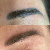 پاک کردن تتو رفع تیرگی لک صورت واریس