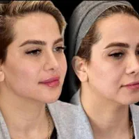 مرکز تخصصی جوانسازی فقط در ۱ جلسه/هایفو/لیفت ۸۹۰ت|خدمات آرایشگری و زیبایی|اصفهان, سودان|دیوار