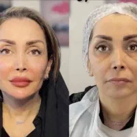 تابستانه مرکز ژل و فیلر،بوتاکس،مزوژل