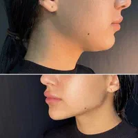 آموزش تزریق فیلر،بوتاکس و لیزر توسط پزشک|خدمات آموزشی|آمل, |دیوار