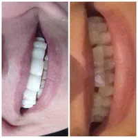 تخفیف فصلی کامپوزیت (1/500ت).عصب کشی در ایرانمهر|خدمات آرایشگری و زیبایی|یاسوج, |دیوار