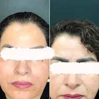 انجام بوتاکس فیلر ژل مزو    اقساط بدون پیش پرداخت|خدمات آرایشگری و زیبایی|کرمان, |دیوار