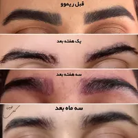 از شر تتوی قدیمیت خلاص شو|خدمات آرایشگری و زیبایی|تربت‌حیدریه, فرمانداری|دیوار