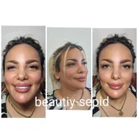 ژل و بوتاکس