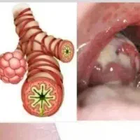 نوشیدنی مخصوص خلط گلو
