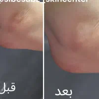 کلینیک سیب سبز ژل و بوتاکس از ۹۰۰ هزار تومان|خدمات آرایشگری و زیبایی|قزوین, |دیوار