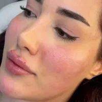 تخفیف ویژه میکرووژل بوتاکس