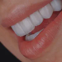 کامپوزیت و ایمپلنت