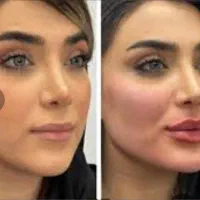 تزریق چربی ،ساکشن غبغب،پی ارپی مو ،مزو زگیل میخچه|خدمات آرایشگری و زیبایی|یاسوج, |دیوار